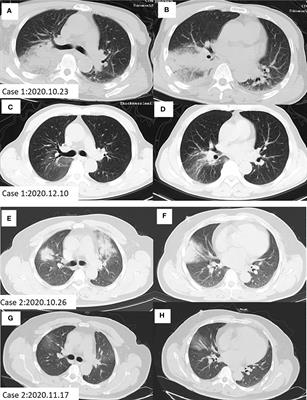 Case report: Clinical characteristics of two cases of pneumonia caused with different strains of Chlamydia psittaci